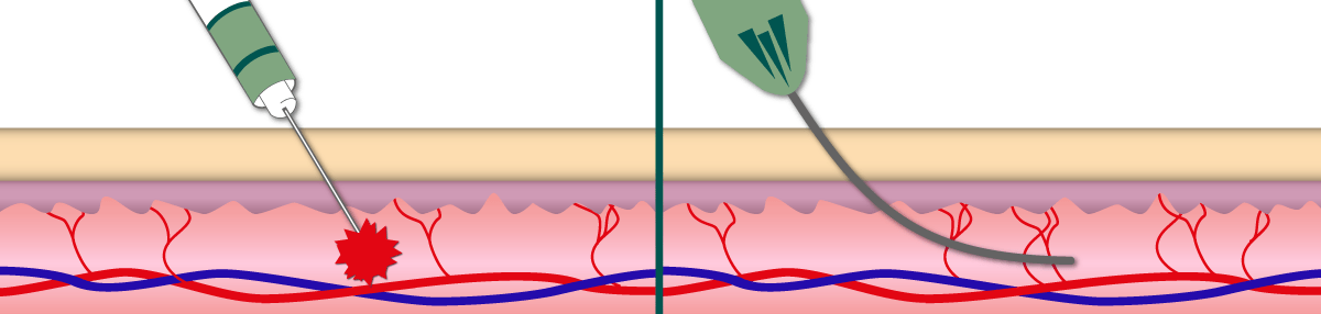 Cannule e aghi nella medicina estetica: scelta, utilizzo e differenze - MR.FiLLER